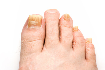 Fungal nail treatment in Houston TX 77024 and Pearland, TX 77584