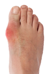Causes of Gout